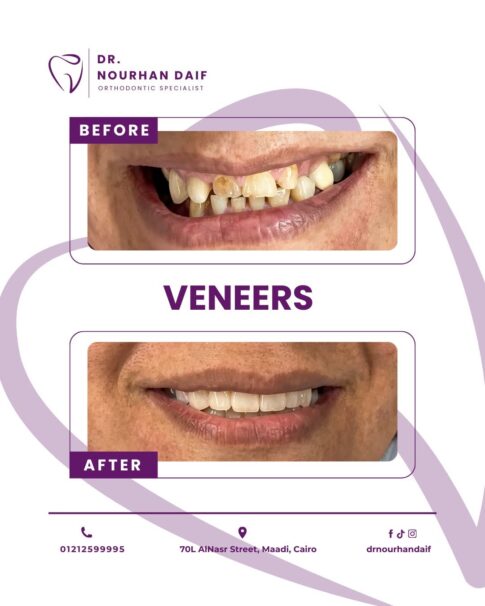 تجميل-الاسنان-في-المعادي.jpg