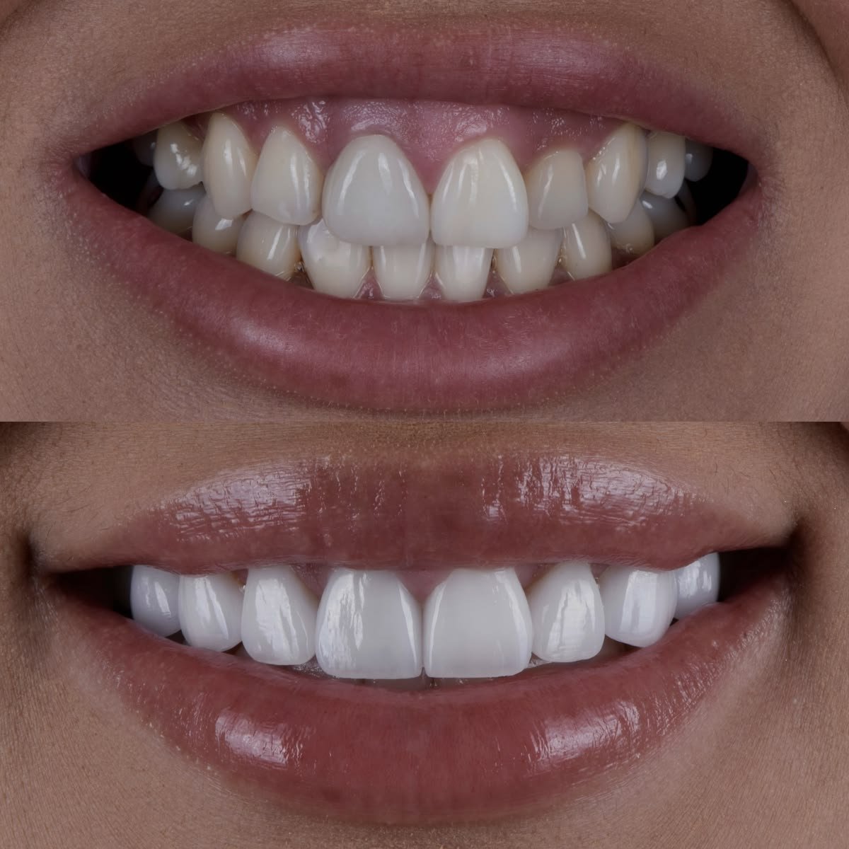 Before and after gum contouring to treat a gummy smile