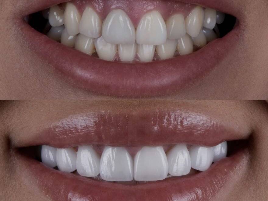 Before and after gum contouring to treat a gummy smile